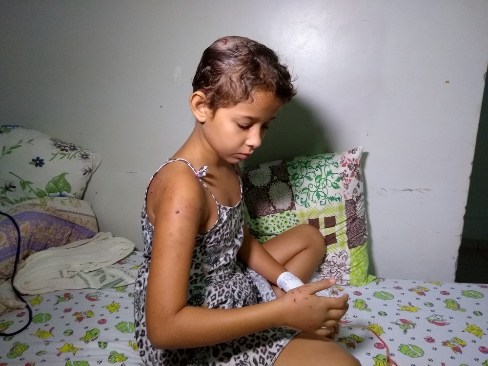 Menina de 10 anos sofre ataque de Pit Bull em Rondônia e leva cerca de 30 pontos na cabeça 