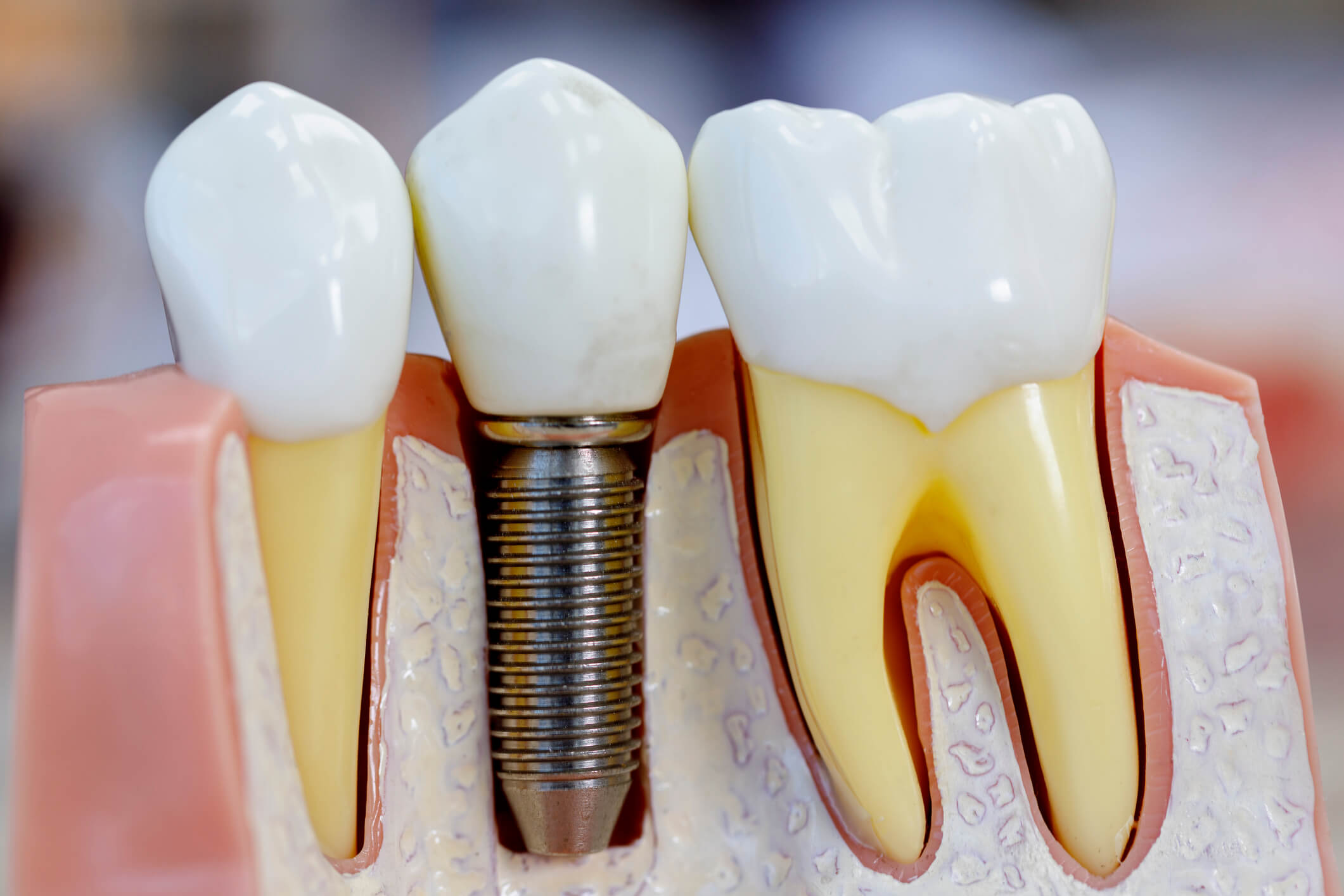 Cerca de 18% dos brasileiros precisam de próteses dentárias, diz IBGE