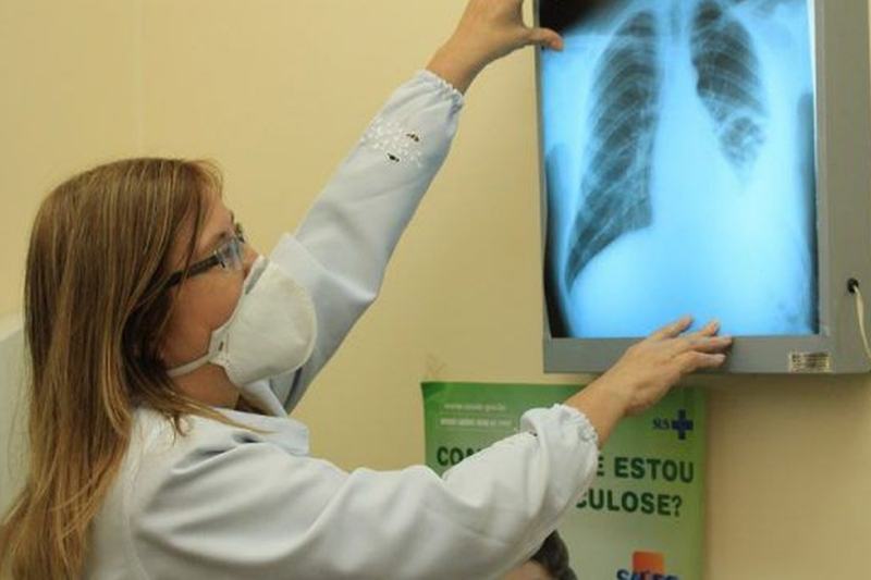 Médico alerta para riscos da tuberculose pulmonar não tratada
