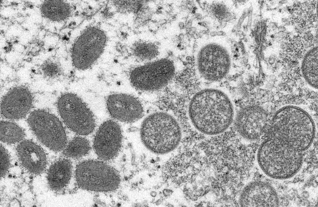 Suzano confirma primeiro caso da varíola dos macacos