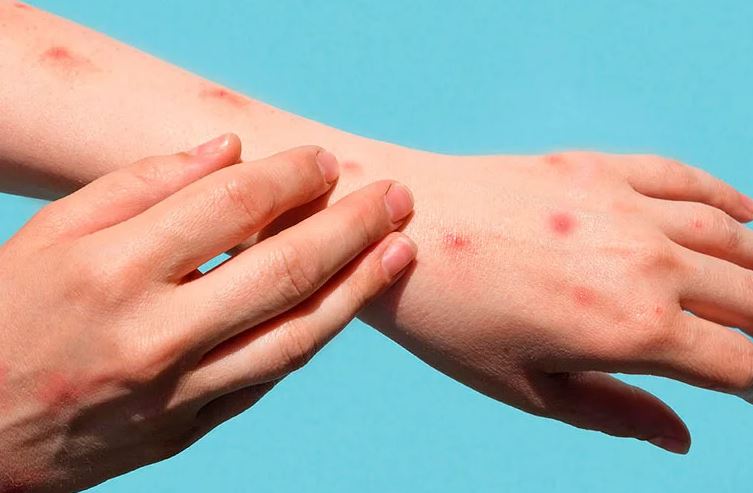 Surto de mpox na África é declarado emergência sanitária internacional pela OMS